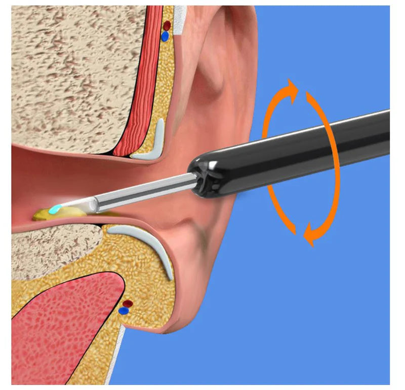 Smart Visual Earwax Removal Kit – See & Clean Safely at Home 👂📱